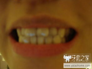 輕微地包天自己恢復嗎