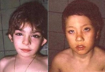 歌舞伎面譜綜合征，男性患者長相會更像母親一些