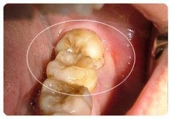 50歲長智齒有什么預示
