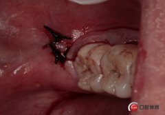 拔智齒不縫針的后果