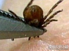 蜱蟲叮咬后傷口圖片,它的頭會鉆進人體內(皮膚會紅腫一片)