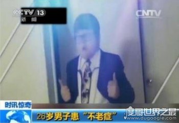 不老癥真的能長生不老嗎，患病“高地人癥候群”(長大／衰老緩慢)