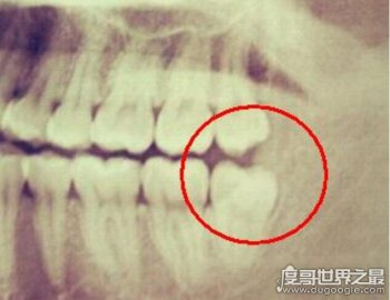 不需要拔的智齒圖片，新生智齒千萬不要拔掉