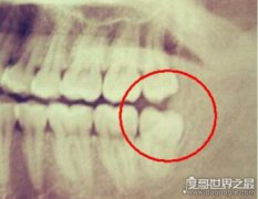 不需要拔的智齒圖片,新生智齒千萬不要拔掉