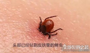 蜱蟲咬人后有什么癥狀，千萬不能盲目將其切除