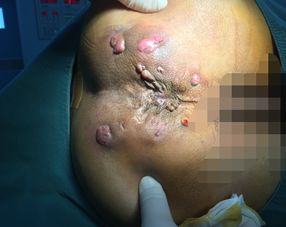 肛瘺后人一輩子都廢了