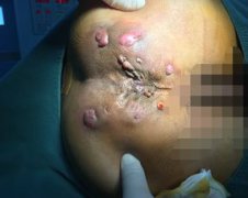 肛瘺后人一輩子都廢了