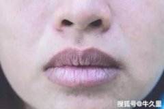 額頭發黑是什么征兆