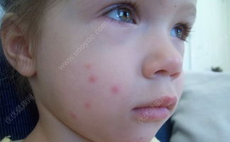 蚊子咬人是公還是母，雌性（母）蚊子咬人