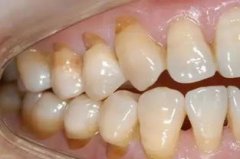 人體最堅硬的組織是,是牙齒有一層釉質包裹