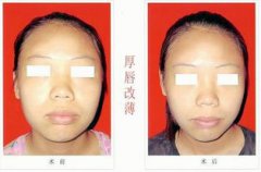 厚嘴唇怎么變薄，平時注意多喝水改掉咬的習慣