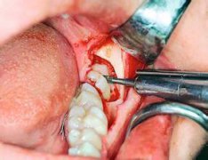 拔智齒多少錢,一般是100-300元左右