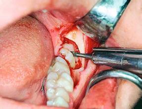 拔智齒多少錢，一般是100-300元左右