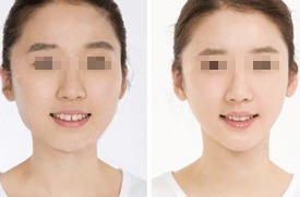 菱形臉怎么改變臉型，可以通過面部吸脂和打瘦臉針矯正