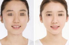 菱形臉怎么改變臉型,可以通過面部吸脂和打瘦臉針矯正