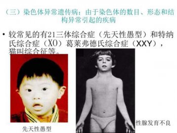 威廉姆斯綜合癥面型,威廉斯氏綜合癥