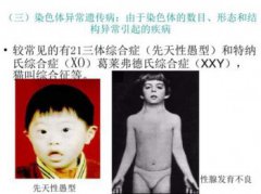 威廉姆斯綜合癥面型，威廉斯氏綜合癥