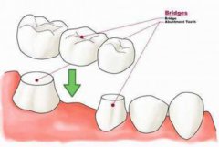 種植牙有什么風(fēng)險(xiǎn)和后遺癥，種植牙和烤瓷牙區(qū)別