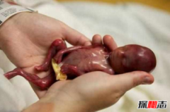 阿米利婭·泰勒現況，世界上最小的嬰兒阿米利婭·泰勒