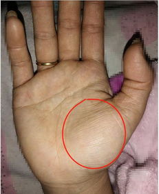 金星丘上好多橫紋,意思是聰明、活潑,思路清晰