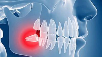 為什么會長智齒，為什么會長智齒的原因