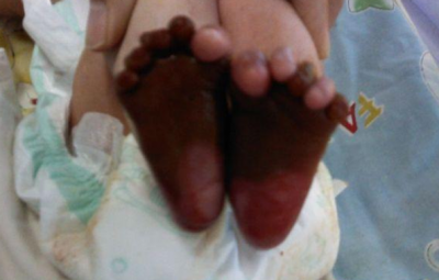 火棉膠嬰兒什么意思，嬰兒表面籠罩了塑料膜一樣