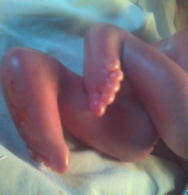 火棉膠嬰兒長大后會正常嗎，和正常嬰兒有很大生理差異