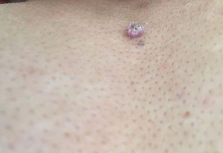 瘊子的位置與命運解析，腰部長瘊子一生奔波勞苦