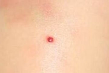 朱砂痣是什么樣子，形似朱砂故而稱為朱砂痣