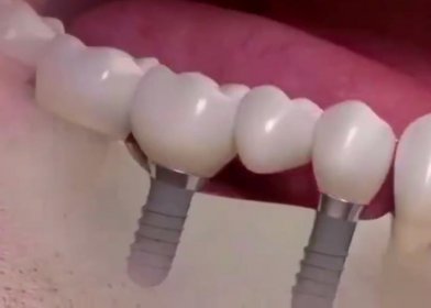 種植牙一顆大概多少錢，一般都要在1萬元左右