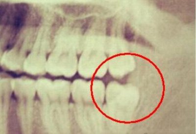 河南拔智齒什么梗,就是很難不支持的諧音